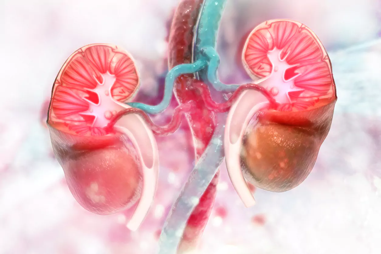 Angiomiolipoma renal: o que é, diagnóstico e gerenciamento