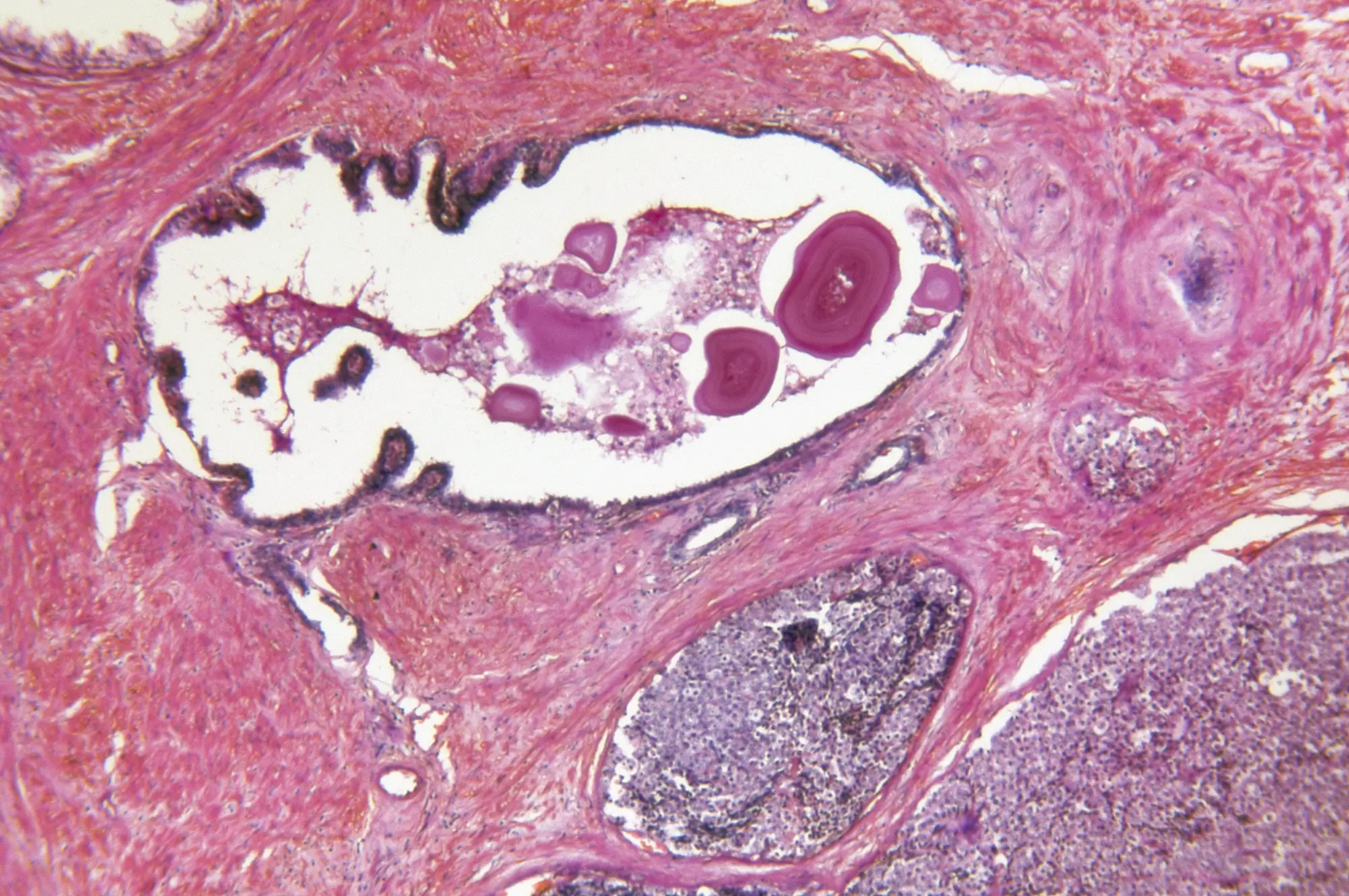 Adenocarcinoma de próstata: informe-se sobre esse tipo de câncer